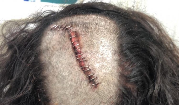 Heridas del escalador que recibió el impacto de una piedra a pesar de llevar casco.