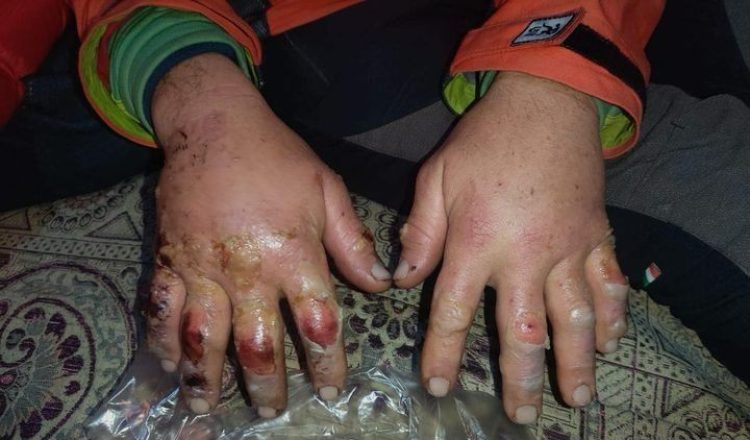 Las manos de Denis Urubko con las congelaciones que ha sufrido al caer en un grieta cuando intentaba el Gasherbrum 1 invernal.